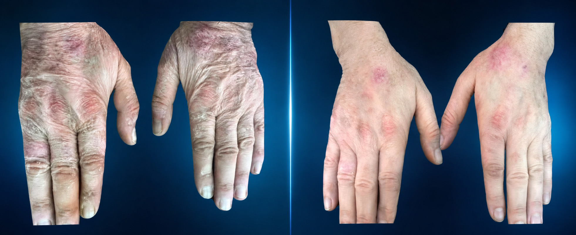 Before-and-after clinical example of patient hands treated by Zag with Myomodulation
